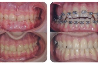 Бруксизм у дорослих: чому скрегіт зубами — це не просто “нерви”