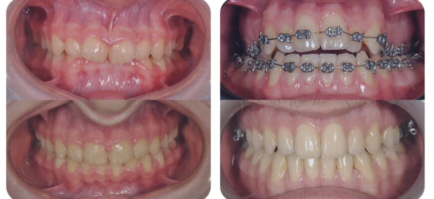 Бруксизм у дорослих: чому скрегіт зубами — це не просто “нерви”