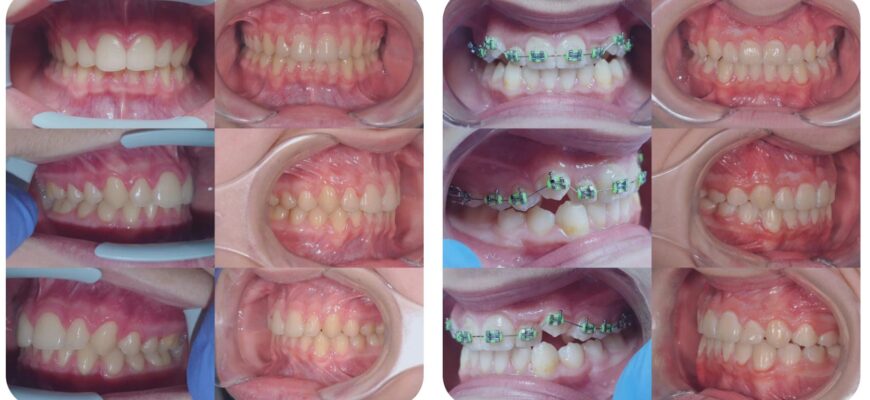 Як порушення прикусу впливають на поставу, головний біль і самопочуття